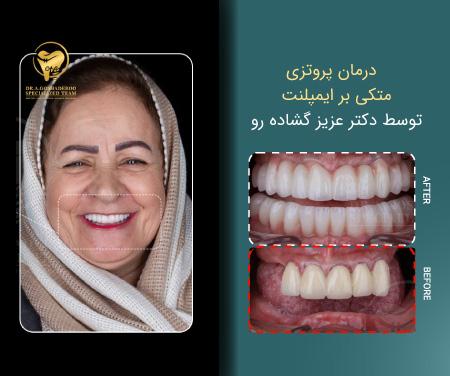 درمان پروتزی متکی بر ایمپلنت